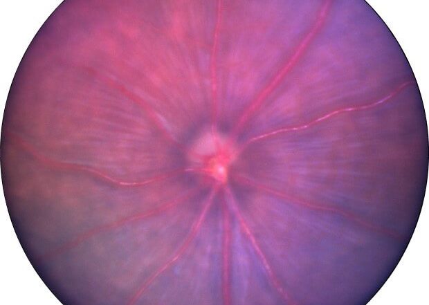 Creating Laser-Induced Choroidal Neovascularization in the Mouse Using Image-Guided Laser Photocoagulation