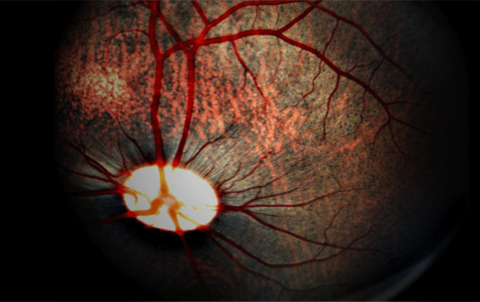 Studying Retinal Function in Large Animals: Laser-Induced Choroidal Neovascularization in Pigs