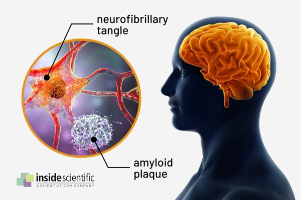 Amyloid Plaques and Neurofibrillary Tangles