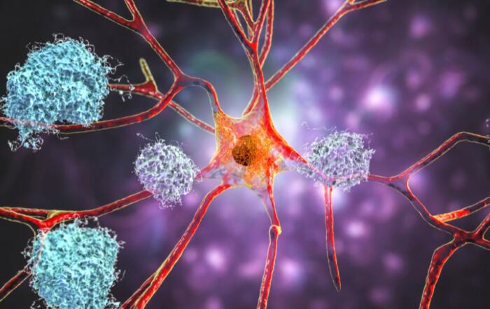 Alzheimer’s Disease: Recent Research & Therapeutic Advances