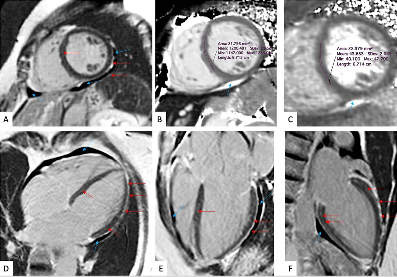 Myocardial mapping of symptomatic patient following mild COVID