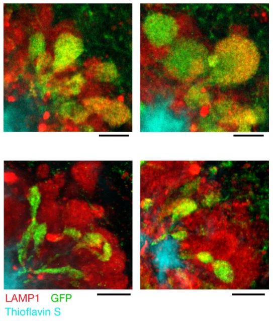 Axonal spheroids expressing Pld3 targeting RNA in mouse model of Alzheimer's disease